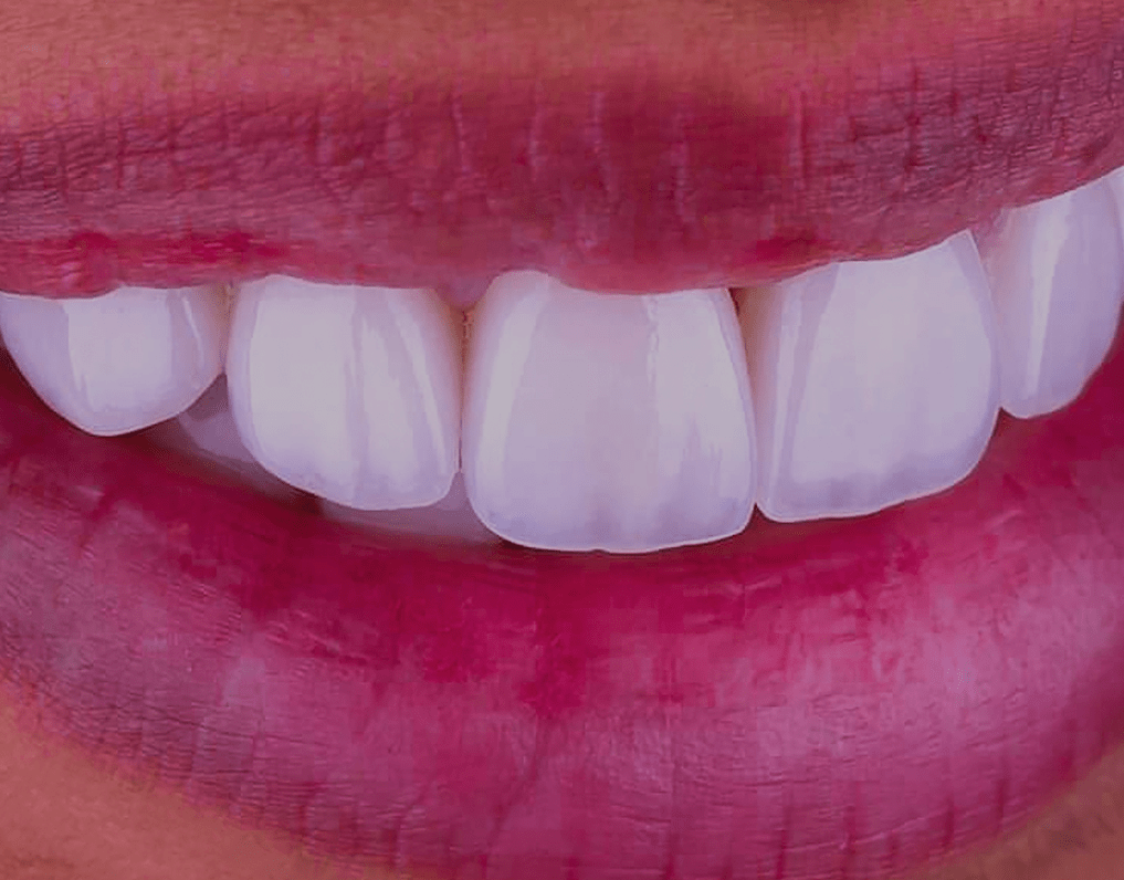 can-you-whiten-veneers-explained-2023-guide-natrusmile