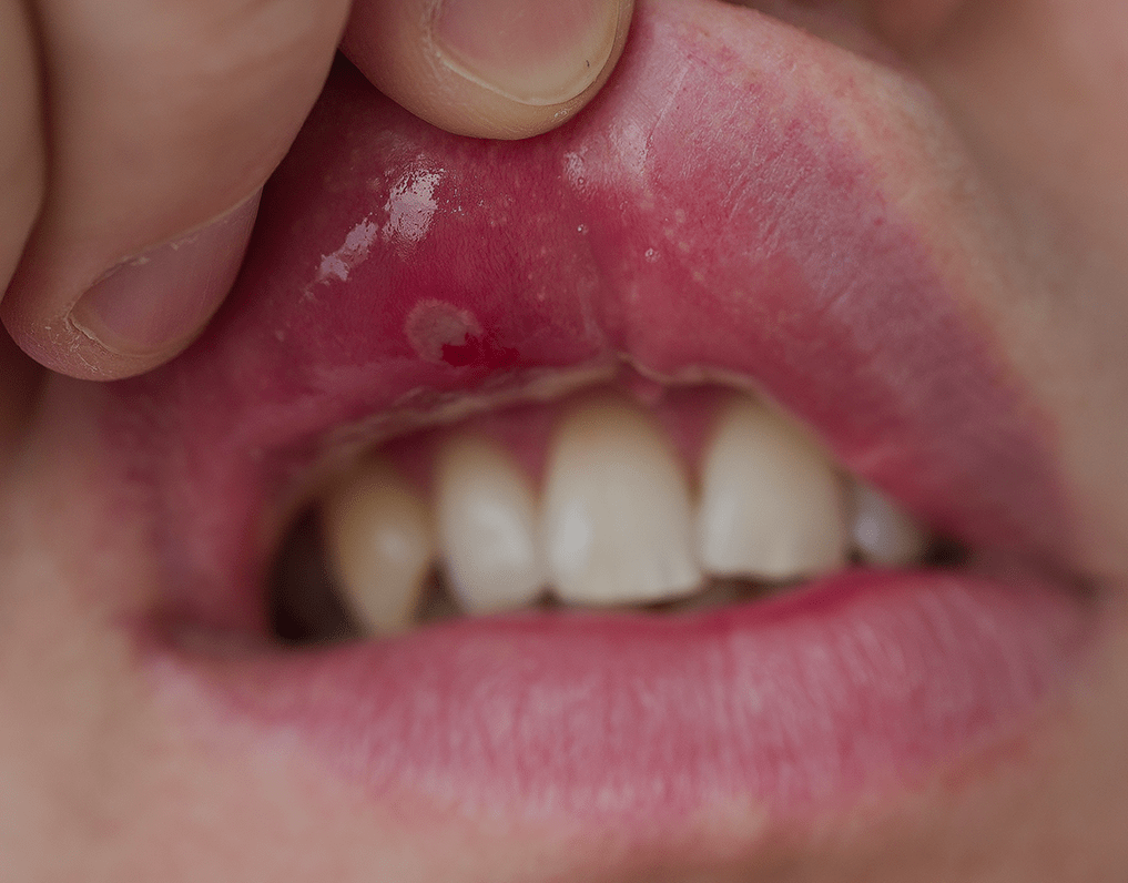 Mouth Ulcers Causes, Treatment & Prevention – NatruSmile