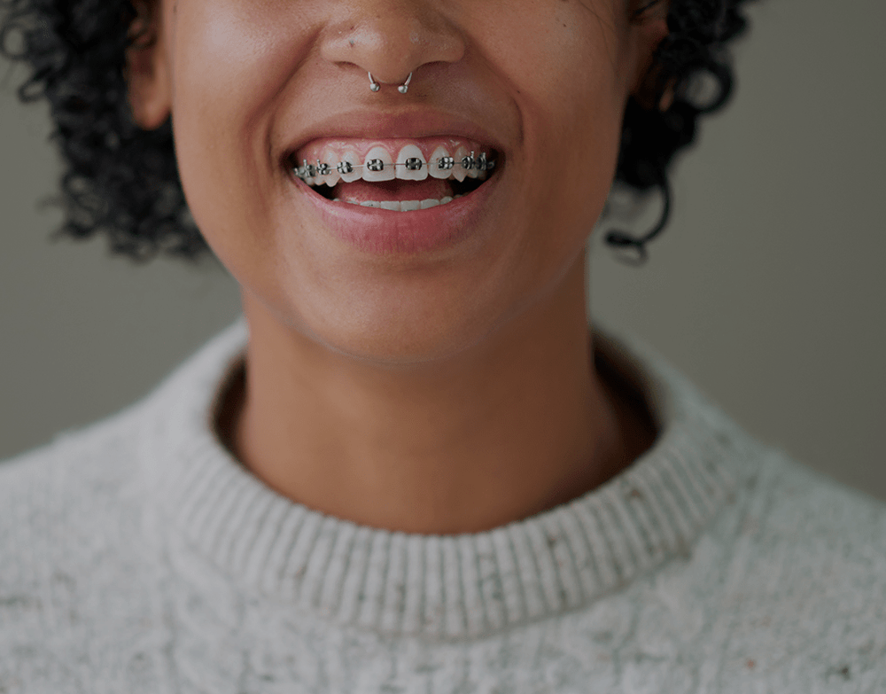 Best Braces Colors To Make Your Teeth Look White Natrusmile 4273