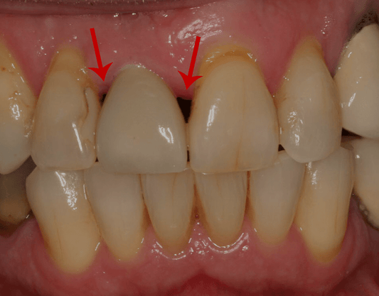 Black Triangles Between Teeth: Causes, Remedies and More