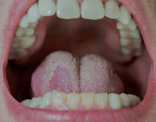 Most Common Oral Infections and Treatment Options