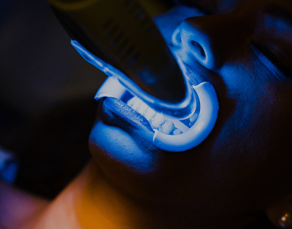 How Much Does Laser Teeth Whitening Cost? – NatruSmile