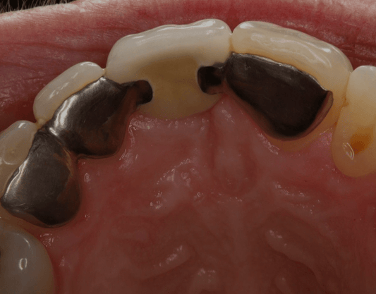 Maryland Dental Bridges: Cost, Procedure, Benefits, and More