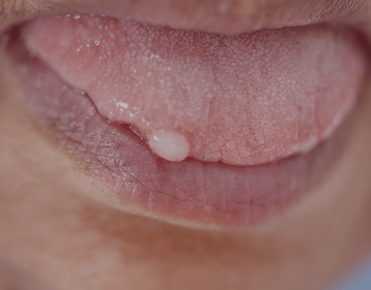 Warts On The Tongue: Types, Causes, And Treatments