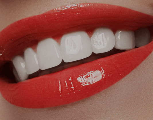 What Are Snap-On Veneers? The All-In-One Guide